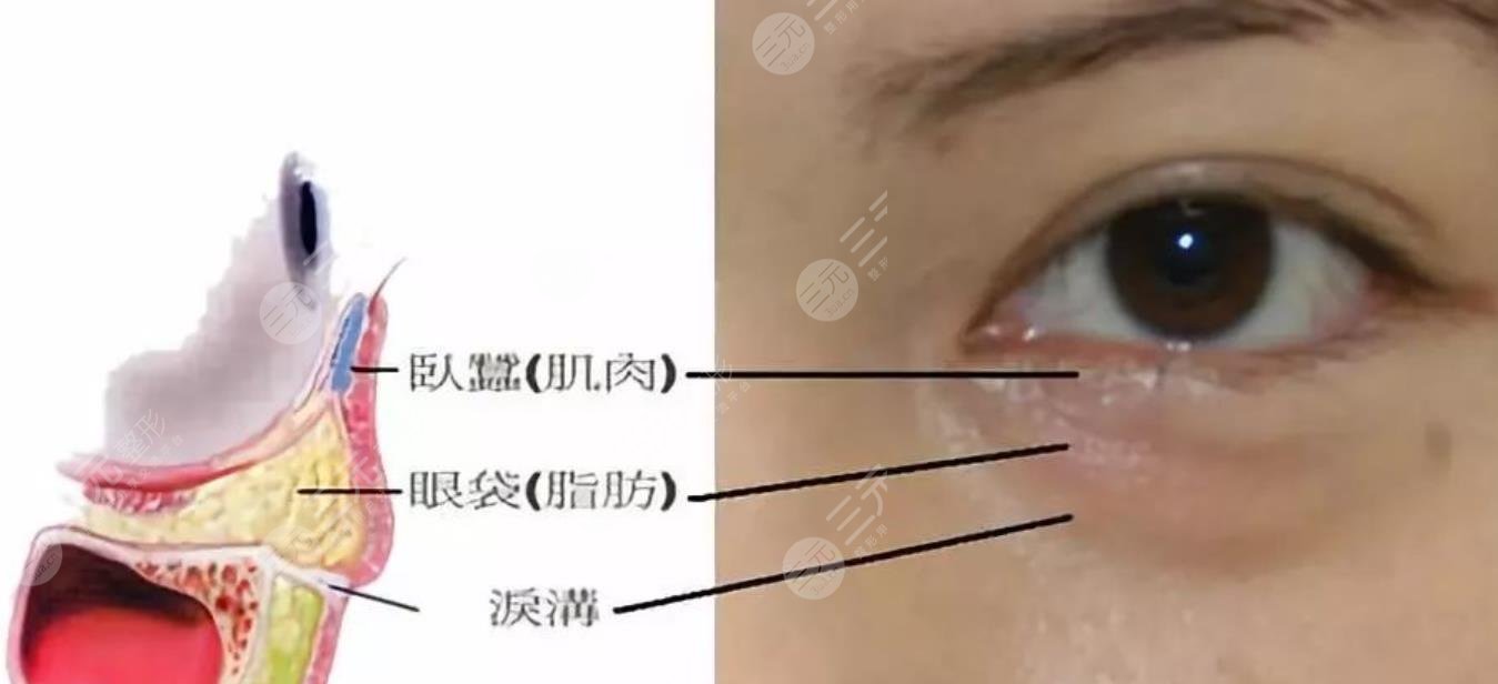 去眼袋