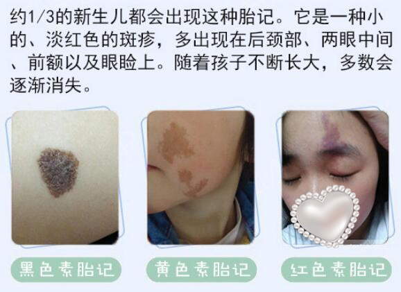 胎记可以去除掉吗？科普解答：2种方法搞定，优势&价格一览！