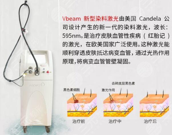 胎记激光能基本去除吗