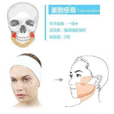 双下巴吸脂