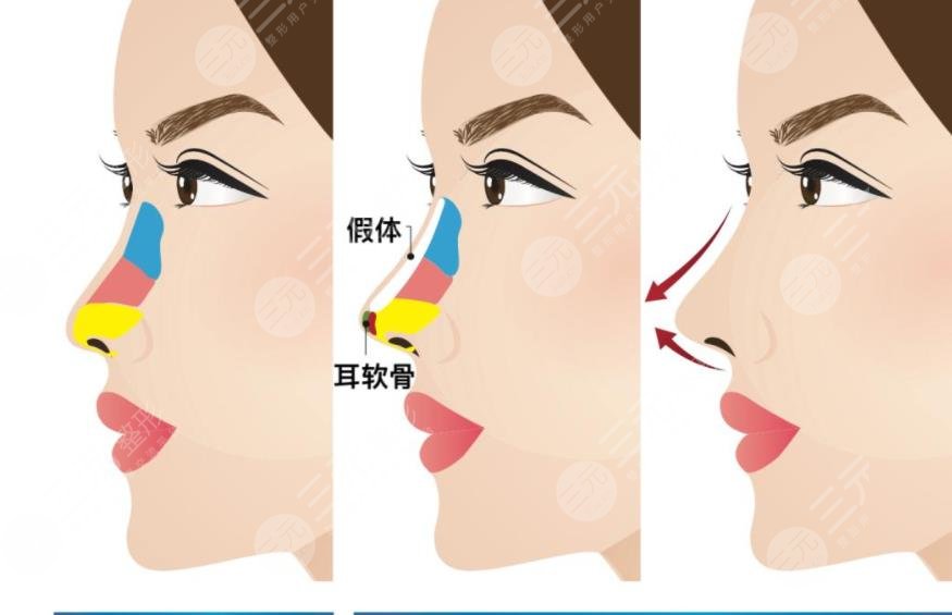 大连做鼻子好的医生排名