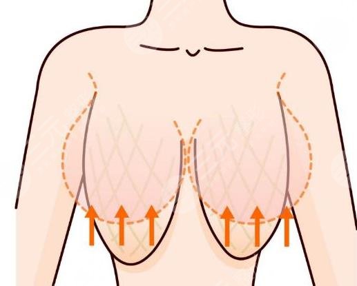 乳房提升棒棒糖是大手术吗?