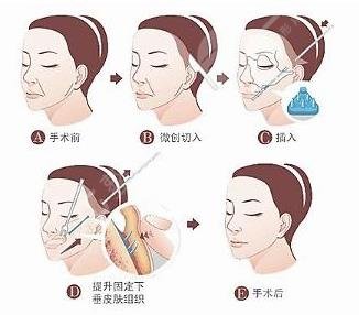 中面部拉皮手术怎么做的?