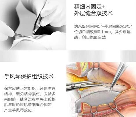 肖庆华双眼皮技术