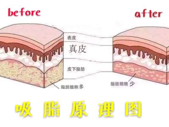 共振吸脂