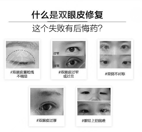 双眼皮修复可以做眼部手术吗