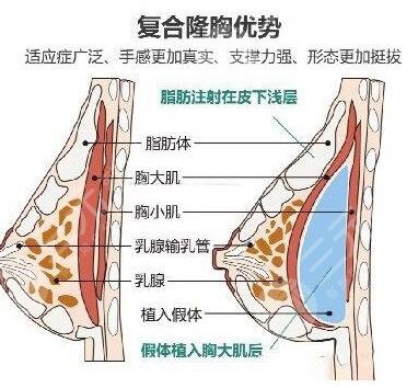 复合隆胸的原理是什么