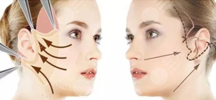 小切口除皱保持几年？小切口除皱的危害及维持时间是多久？走进科普