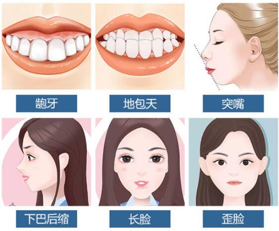 哪些人须要做正颌手术缓解