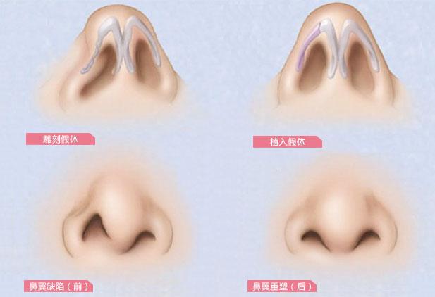 鼻翼变窄整形手术如何做?多少钱?科普&价格,分享塑造美鼻的秘密!