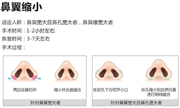 鼻翼变窄整形手术如何做?多少钱?科普&价格,分享塑造美鼻的秘密!