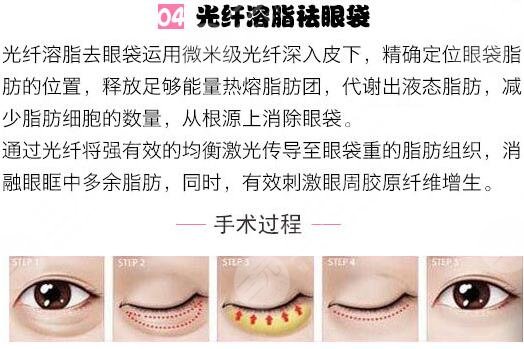 目前做眼袋良好的技术是什么？降低风险吗？