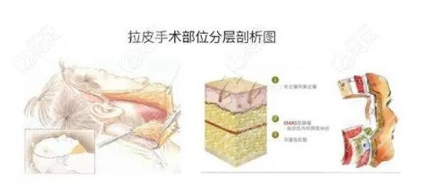 小切口拉皮手术