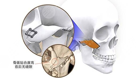 磨颧骨是什么原理?
