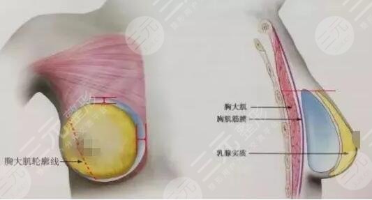 硅胶隆胸的优点