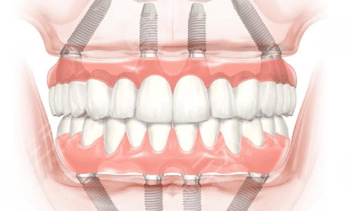 什么是全口种植牙