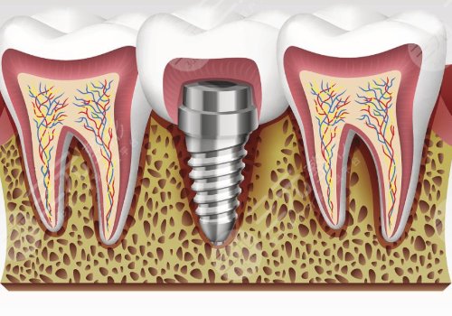 全口种植牙的寿命一般是多久？种植牙维持时间及怎么延长种植牙的寿命？