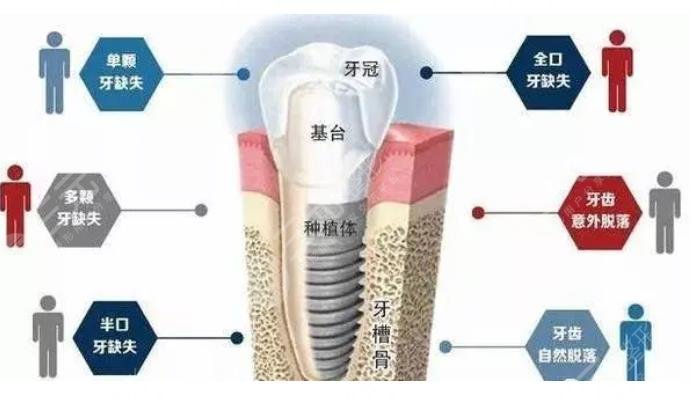 种植牙有什么风险