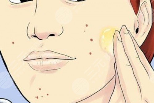 彩光祛痘注意事项