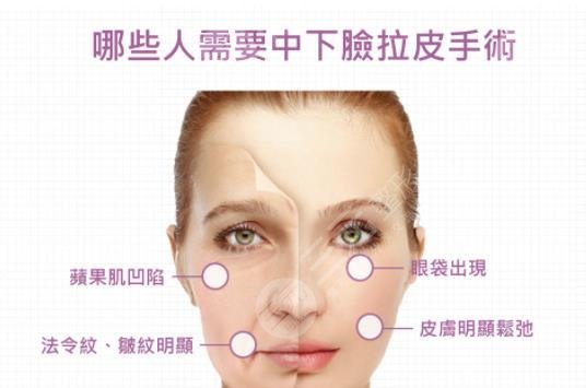 上海九院拉皮手术科普