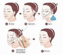 拉皮手术能维持几年?多少钱?“恢复期_适合年龄”术前要了解哦~ 拉皮手术能维持几年?多少钱?“恢复期_适合年龄”术前要了解哦~