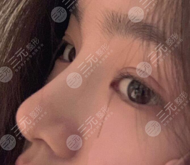 鼻部手术整形果好不好