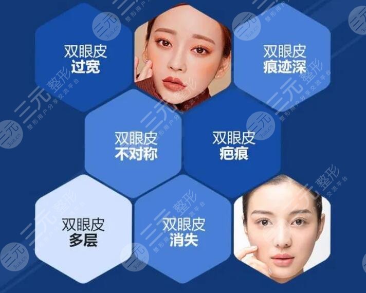 双眼皮修复手术