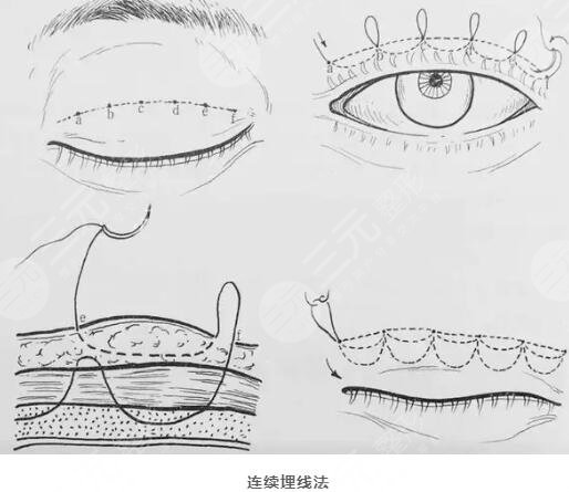 压线双眼皮的原理