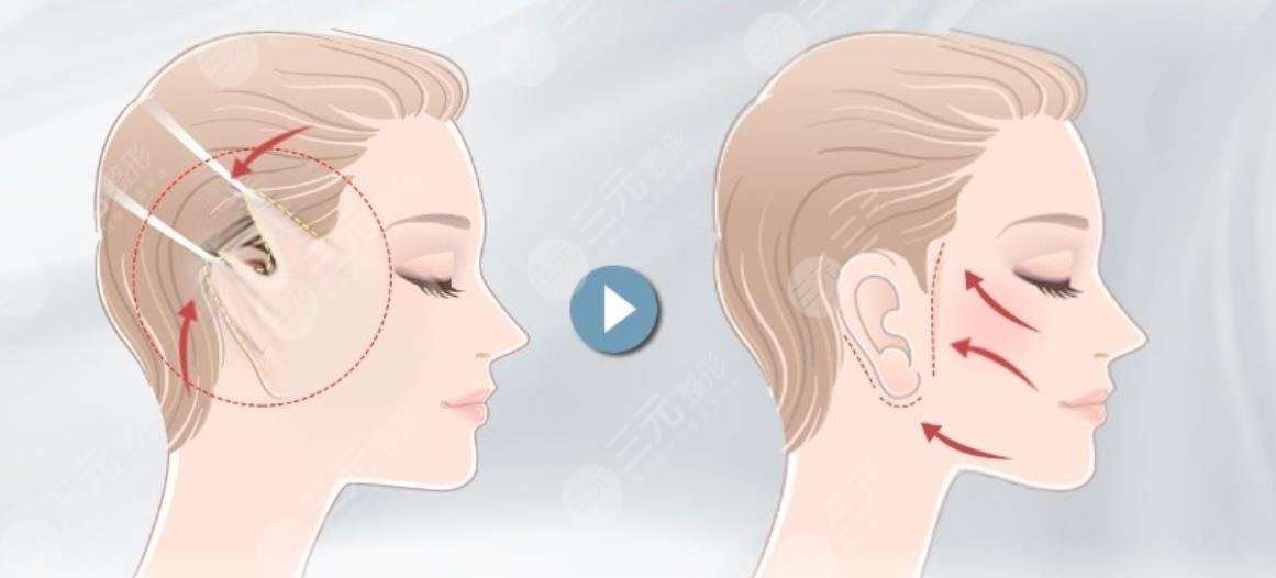 小拉皮手术过程