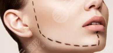 做拉皮手术的注意事项