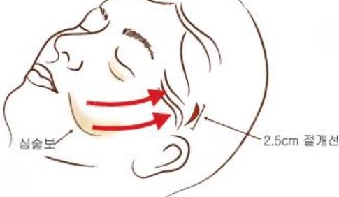 做拉皮手术的注意事项