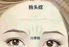 川字纹用什么填充果好?材料科普&注意事项讲解,祛皱不用愁! 川字纹用什么填充果好?材料科普&注意事项讲解,祛皱不用愁!