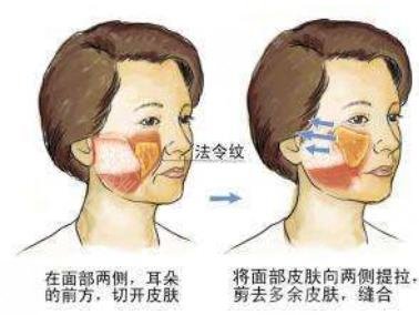 小拉皮和大拉皮手术有什么区别