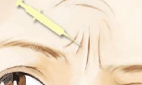 注射注射除皱能保持多久