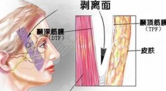 小拉皮和大拉皮手术有什么区别?该如何选择才能让你变年轻? 小拉皮和大拉皮手术有什么区别?该如何选择才能让你变年轻?