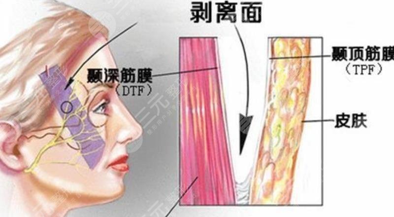 小拉皮和大拉皮手术有什么区别