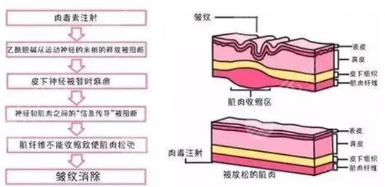 注射注射除皱的副作用