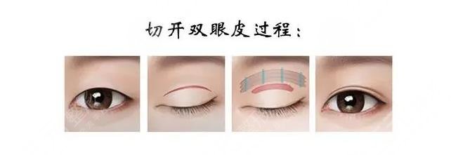 全切双眼皮