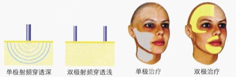 射频除皱能维持多久？果维持时间|注意事项有什么？【抗衰干货】