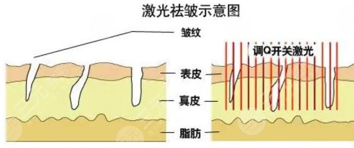 射频除皱原理