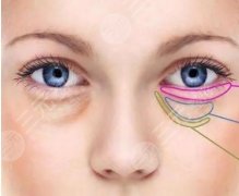 国内眼袋手术成熟吗？内切还是外切好，多少钱？超全去眼袋知识分享！