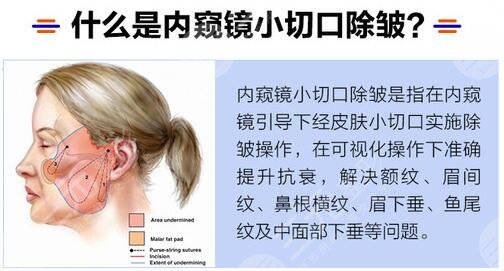 小切口除皱