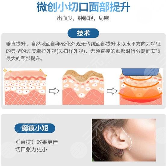 内窥镜除皱手术大概多少钱,成好吗?图文讲解抗衰过程,附参考价!