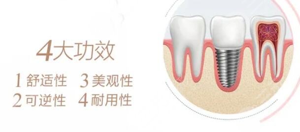 全口种植牙术后可以维持多久