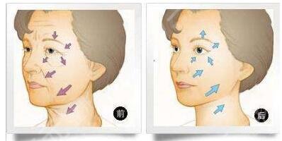 内窥镜拉皮手术的注意事项