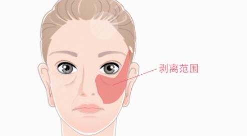 内窥镜拉皮手术术后会有什么样的改变