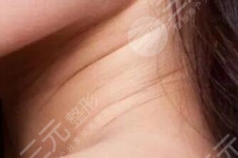嗨体去颈纹
