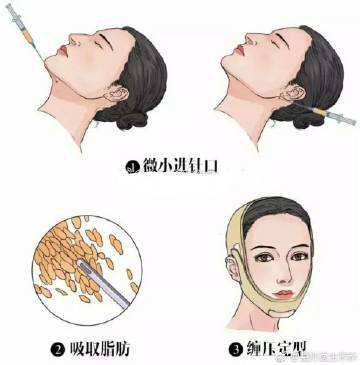 双下巴溶脂和抽脂哪个好?