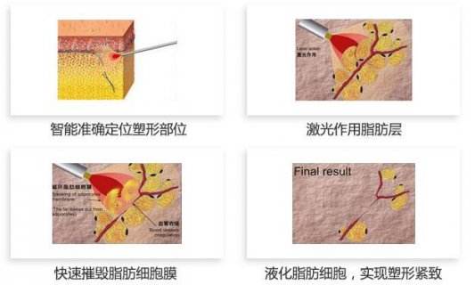 双下巴溶脂和抽脂