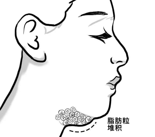 双下巴